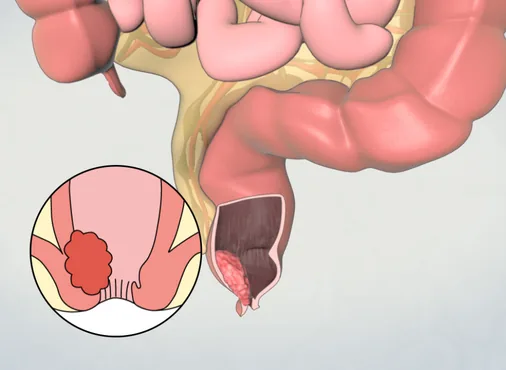 Abdominoperineal Resection (APR) - Very Low Rectal Cancer consultation at Niraaya Hospital